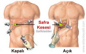 Safra Kesesi Hastalıkları 2 - Op. Dr. Selçuk Kihtir